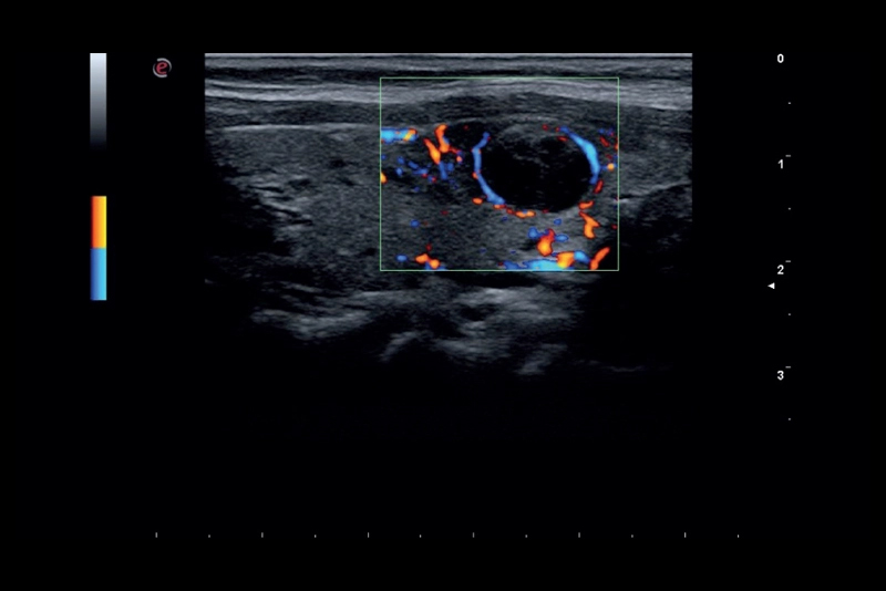 Ecografie con ecocolordoppler